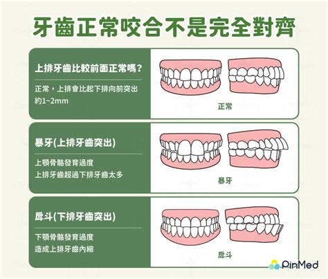 上排牙齒蓋住下排牙齒|咬合不正怎麼辦？會影響臉型？原因、矯正方式一次看。